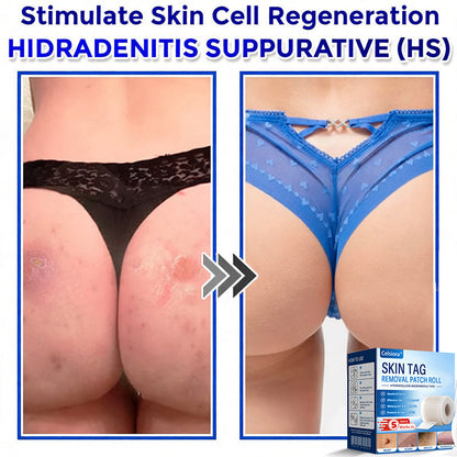 🍁🌟Celsiora® Multi-Functional Microneedle Hydrocolloid Patch Roll | Targets Skin Tags, Warts & Stubborn Blemishes
