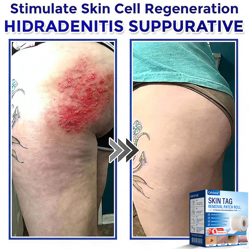 🍁🌟Celsiora® Multi-Functional Microneedle Hydrocolloid Patch Roll | Targets Skin Tags, Warts & Stubborn Blemishes