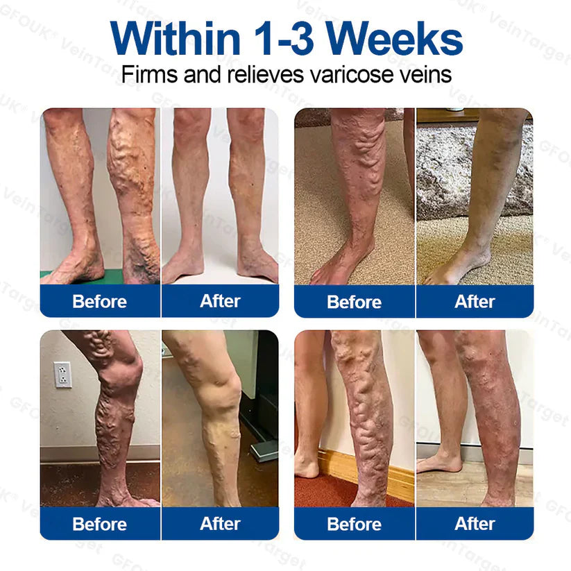 🍁😻GFOUK® VeinTarget Microneedle Patch⚡Instant Relief, Long-Term Results